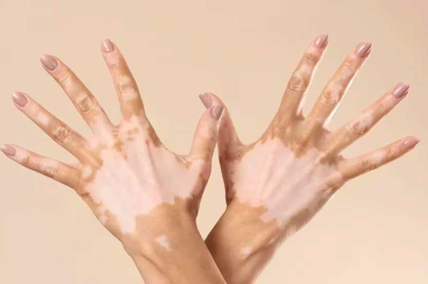 Vitiligo- claves sobre esta condicioacuten que afecta la pigmentacioacuten de la piel