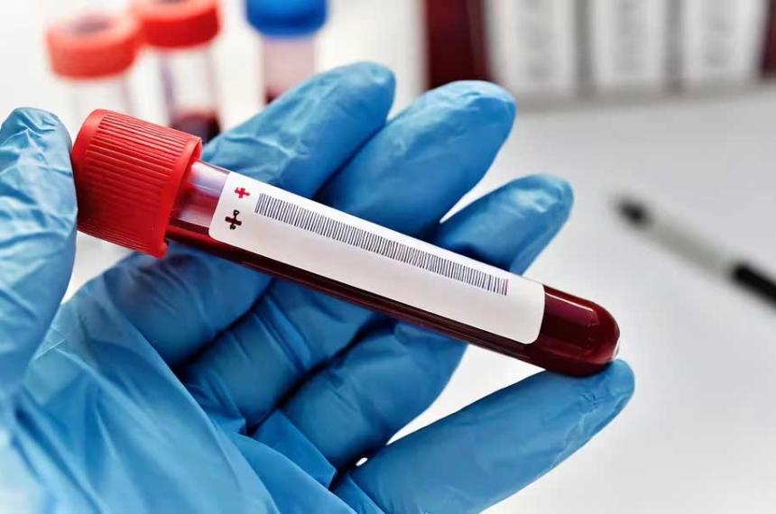 Hacia la cura del VIH- confirman un nuevo caso con carga viral indetectable tras un trasplante de ceacutelulas madre