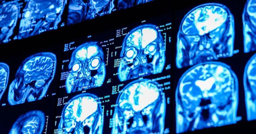 Nuevo estudio revela que un caso grave de covid-19 envejece el cerebro 20 antildeos