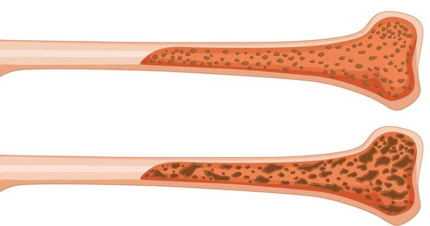 Una nueva inyeccioacuten de hidrogel podriacutea reforzar huesos fraacutegiles en semanas